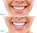 Professional Strength Teeth Whitening Kit Includes XL Syringes Duplex Mouth Tray LED Accelerator Light 5 Syringe Kit