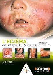 L' eczéma