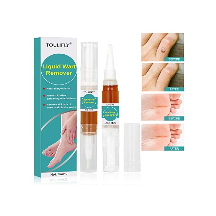 Wart Remover,Foot Wart Remover,Plantar Wart Remover,Wart Remover Liquid Pen Corn Callus Remover Liquid for Common Warts…