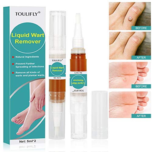 Wart Remover,Foot Wart Remover,Plantar Wart Remover,Wart Remover Liquid Pen Corn Callus Remover Liquid for Common Warts Plantar Corn Callus Stops Wart Regrowth