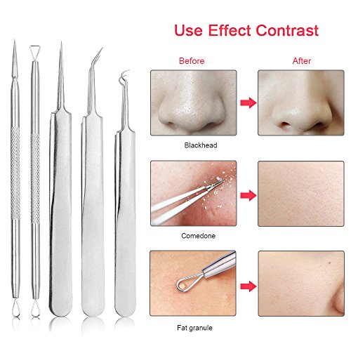 Blackhead Whitehead Splinter Remover Cure Pimples Comedones Zit