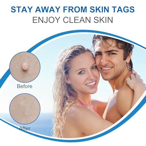 Skin Tag Removal Kit - Fast-Acting, Safe, and Effective Skin Tag Remover for All Skin Types -Complete Skin Tag Removal Kit with Detailed Instructions- Achieve Clear, Smooth Skin Quickly and Painlessly