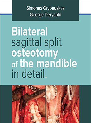 Bilateral Sagittal Split Osteotomy of the Mandible in Detail