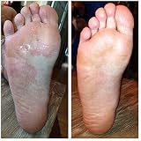 Imperial Feet Athletes Foot Shoe Spray 150 ML Fungal Nail Treatment view 7