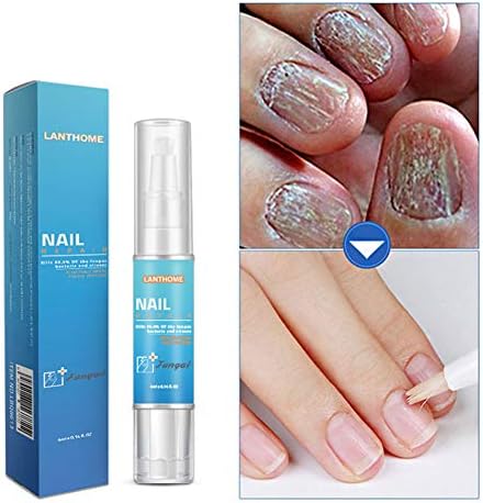 Sweetds Anti Fungal Nail Solution Onychomycosis Paronychia Treatment Nail Toe Repair Pen (A)