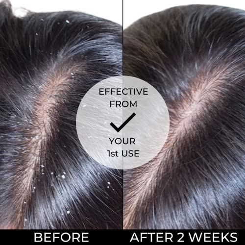 Alevai Stem Cell Anti Dandruff Shampoo Itchy Scalp Treatment Safe