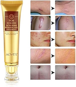 acne marks removal
