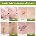 Acne Scar Remover, Acne scar treatment, Scar Removal, Scar Gel, Scar Remover Gel for Face Body, Old & New Scars from Cuts, Stretch Marks, C-Sections & Surgeries, Natural & Gentle