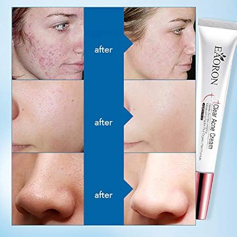 eaoron clear acne cream