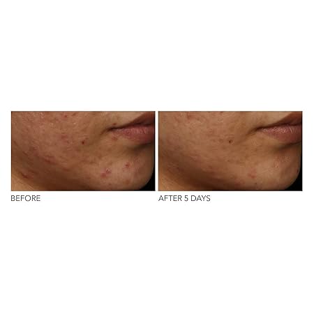 dr dennis gross drx spectralite faceware pro