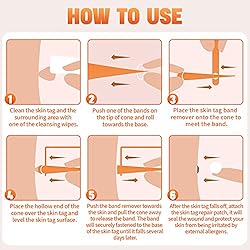 Painless Safe Skin Tag Remover Device Kit Micro