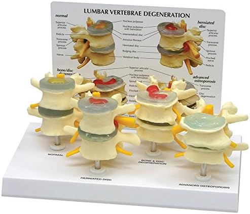 Anatomical Model, 4 Stage Vertebrae