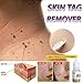 Meflying Strength Skin Tag Remover Foot Treatment Mole Skin Tag Body Warts Remover Skin Care Tools