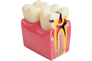 Pevor New Dental Teeth Model Dental Caries Tooth Model Patient Education Teeth Model 6 Times Caries