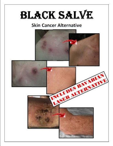 BLACK SALVE Skin Cancer Alternative