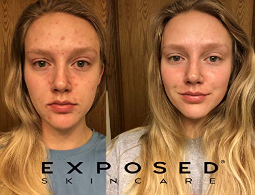 2 Exposed+Skin+Care+Treatment+Formulated