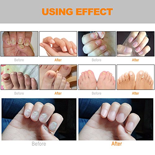 OTBBA Toenails & Fingernails Repair, Toenails Treatment Pens, Effective Personal Care Supply, 4 Pcs (4)