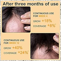 Minoxidil for Men 5% Minoxidil Foam for Hair growth