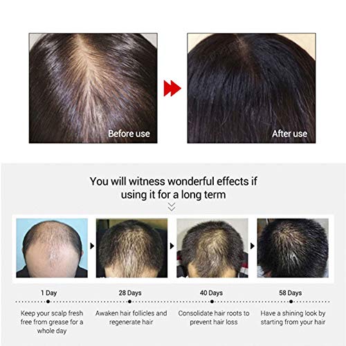 Kasien Hair Growth Liquid, Natural Ginger Hair Growth Essence liquid Fast Hair Growth Natural Hair Loss Treatment (2 Pcs)