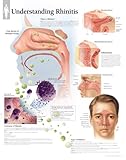 Image de Understanding Rhinitis chart: Wall Chart