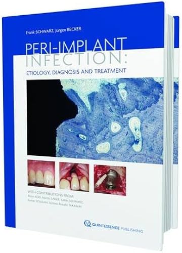 Download Peri-implant Infection: Etiology, Diagnosis and Treatment PDF