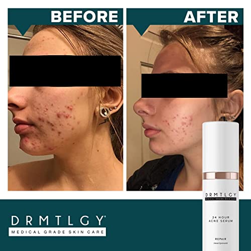 DRMTLGY Acne Spot Treatment and Cystic Acne Treatment. Acne Serum with