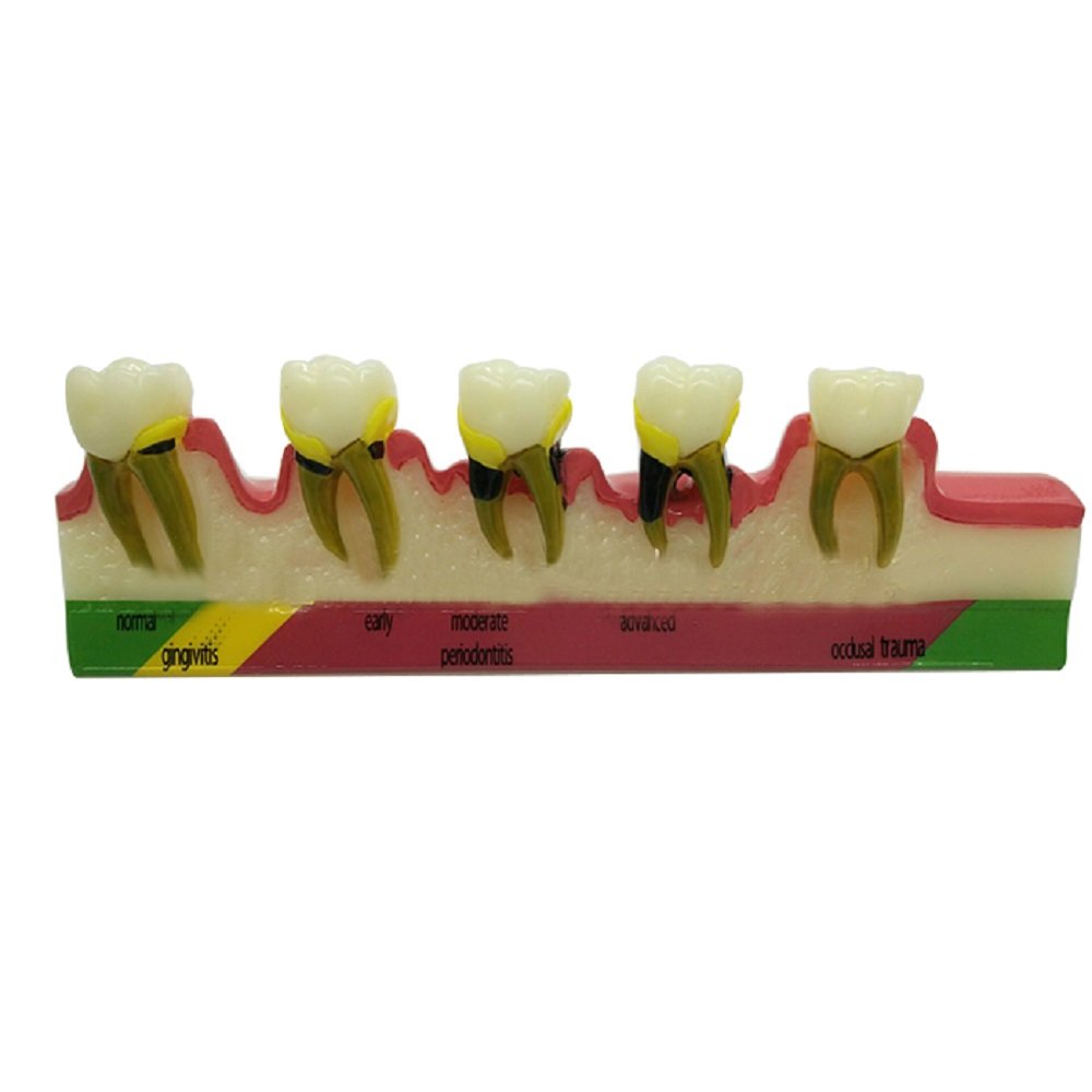Pevor Dental Teeth Model Periodontal Disease Assort Tooth Typodont Study Teaching Model