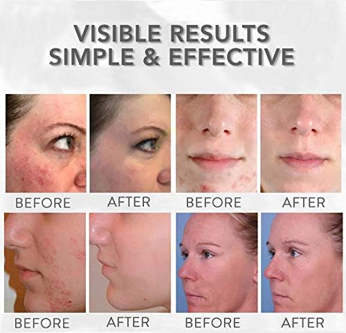 red light therapy for face