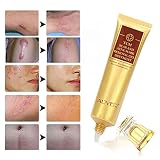 TCM Scar Cream-Acne Scar Removal Cream-Skin Repair Scars Burns Cuts Pregnancy Stretch Marks-Acne Spots Acne Treatment Blackhead Whitening Cream Stretch Marks for Body
