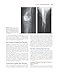 Rockwood and Wilkins' Fractures in Children