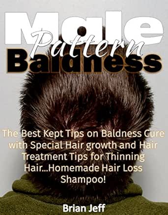 Amazon Com Male Pattern Baldness The Best Kept Tips On Baldness