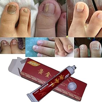 Amazon Com Nail Fungus Treatment Onychomycosis Paronychia Anti