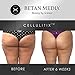 Betan MediX Proven by Plastic Surgeons: Cellulite Cream and Massager - CellulitiX