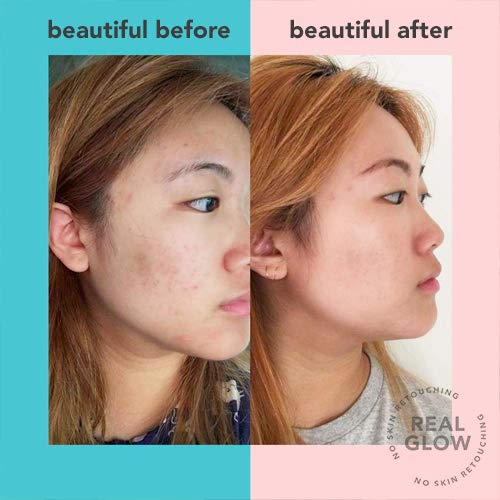 tula acne correcting gel