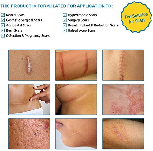 Aroamas Professional Silicone C-Section Scar Removal Sheets, Soft Adhesive Fabric Strips, Drug-Free, Relieves Itching, Remove Keloid Scars, Acne. 5.9" ✕ 1.6", 4 pcs (2 Month Supply), Beige