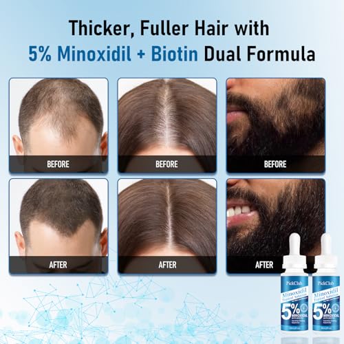 Pickclub 5% Minoxidil with Biotin for Men and Women, Hair and Beard Regrowth Serum, Gentle, Fast-Absorbing, with Dropper, 4-Pack (8.12 fl oz)
