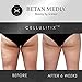 Betan MediX Proven by Plastic Surgeons: Cellulite Cream and Massager - CellulitiX
