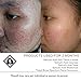 ASDM Beverly Hills Salicylic Acid Peel 10% 1oz 30ml, Made IN USA, Vegan, BHA Salicylic Chemical Peel Exfoliate Treatment for Face and Body