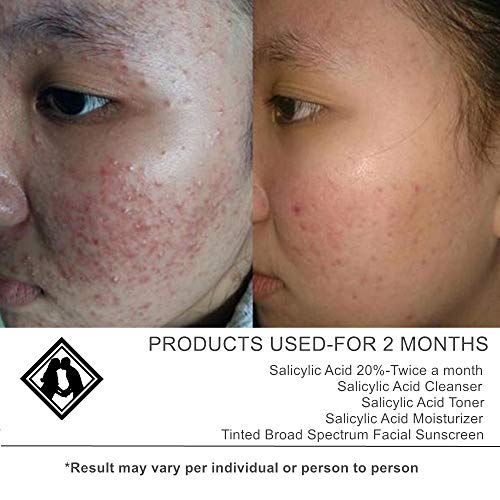 ASDM Beverly Hills Salicylic Acid Peel 20 2oz 60ml, Made IN USA, Vegan, BHA Salicylic Chemical