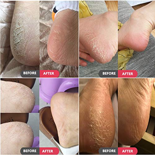 VÉZAAR Foot Dead Skin Pusher Pedicure Foot File Massager, Calluses Remover, Colossal Feet Rasp Care Professional Foot SPA Tool for Cracked Corns Cuticle Hard Skin, Stainless Steel Coarse Gift Files - Thumbnail 5