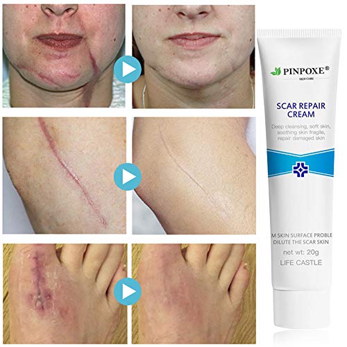 medical grade stretch mark cream
