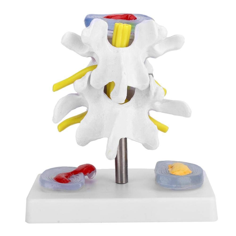 Lumbar Model Anatomical Lumbar Disc Herniation Demonstration Model Human Spine School Training Supplies