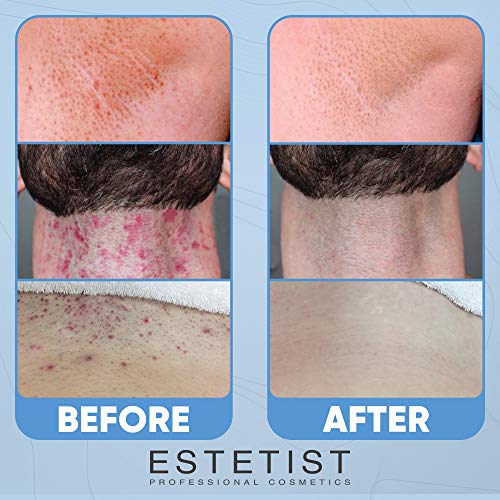 Razor Bump Stopper Solution for Ingrown Hair Skin Care Treatment for