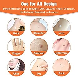 Painless Safe Skin Tag Remover Device Kit Micro