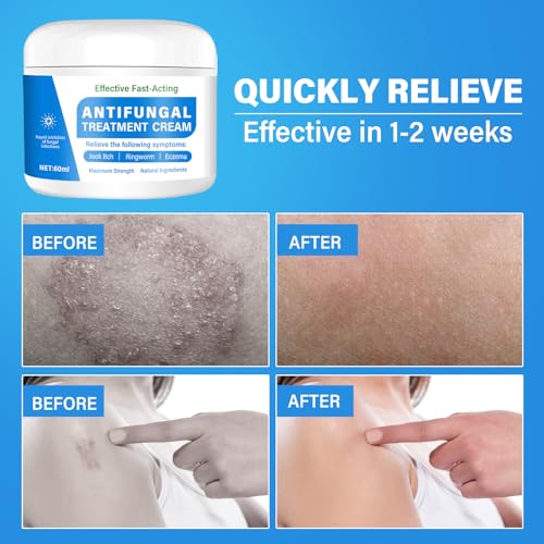 Skin Fungus Cream, Foot Fungus Relief Quick Intensive, Antibody Ringworm, Eczema, Sweat Bubbles, Non-Irritating, Suitable for Face and Body Care, 60 g