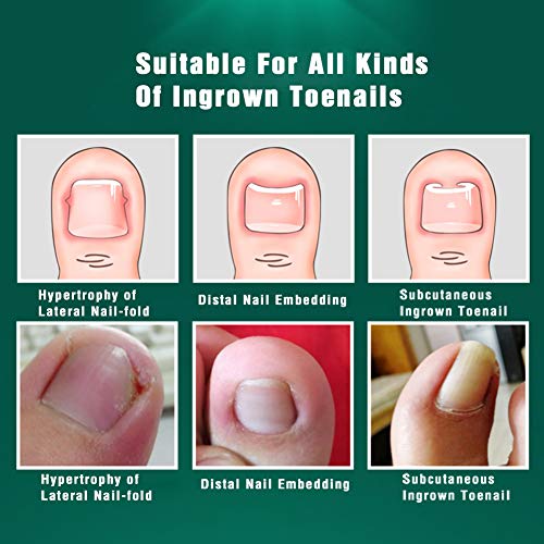 BEZOX Ingrown Toenail Tools, 2PCS Ingrown Toenail Correction Buckle and