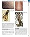 Andrews' Diseases of the Skin: Clinical Dermatology