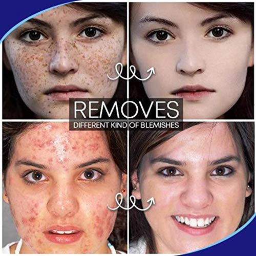 Louyue Freckle Remover,Dark Spot Corrector,Skin Lightening,Brightening Serum for Face Dark Spots Freckles Sun Spots Melasma Fade Hyperpigmentation Even Skin Tone Anti Aging Skin Care (30g)