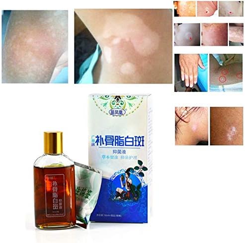Sweetds Medical Professional Treatment For Skin White Spot Vitiligo Eczema Sweatstain Solution