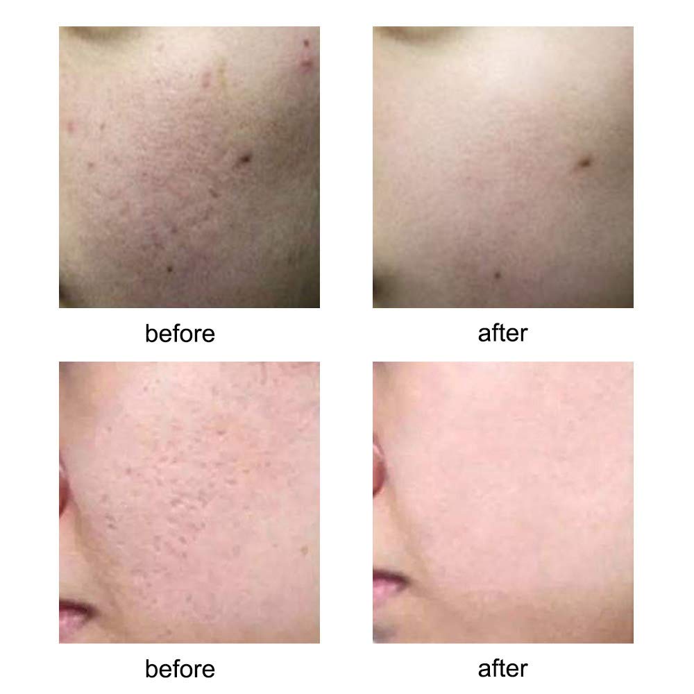 Professional Beauty Facial Body Beauty Devices 40Pin Titanium Derma Stamp Pen(0.5): Beauty